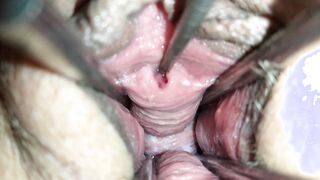 Vagina spreader 