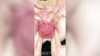 Mon énorme trou du cul ruiné avec gros prolapse anal et gros gode