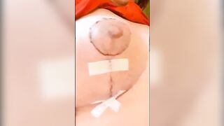 Progression of my hooters surgery, from an E-F cup to a huge C