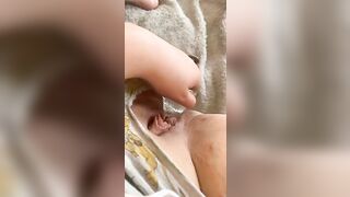 First long anal