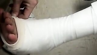 Foot cast placed on twink and his leg before being taken off