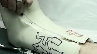 Foot cast placed on twink and his leg before being taken off