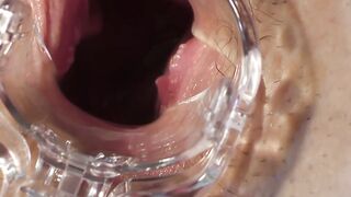 Lucia Cervix Gape
