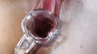 Lucia Cervix Gape