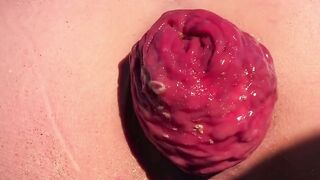 Outdoor Beach Exposure - Nude Woman Suffers from anal Prolapsis